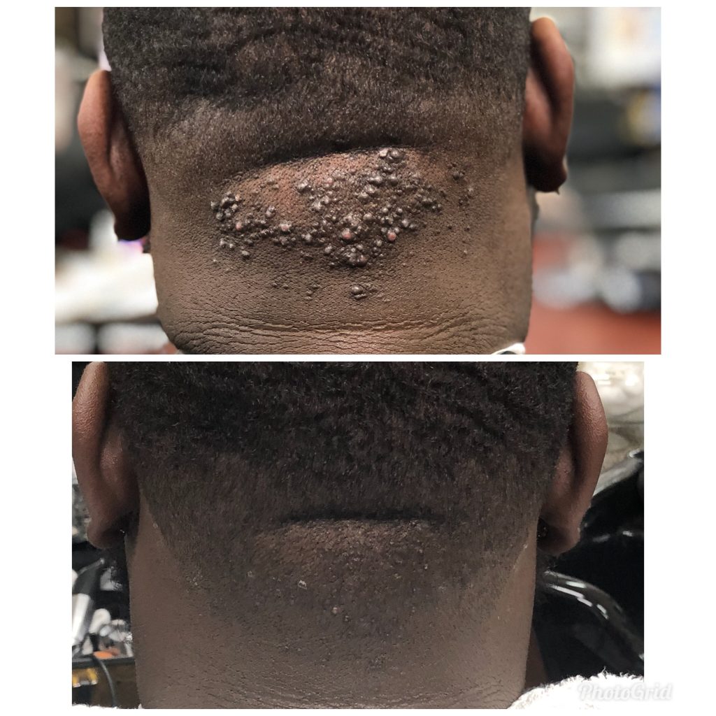 Keloidnalis Nuchae Treatment