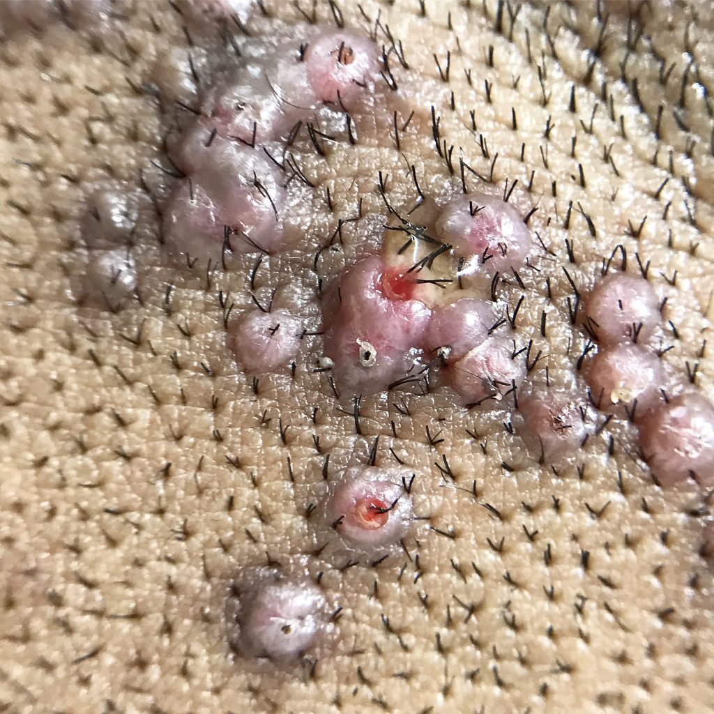 Keloidnalis Nuchae Treatment